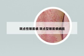 斑点性银屑病 斑点型银屑病病因