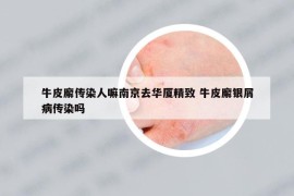 牛皮廨传染人嘛南京去华厦精致 牛皮廨银屑病传染吗