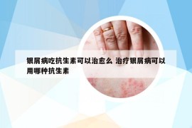 银屑病吃抗生素可以治愈么 治疗银屑病可以用哪种抗生素