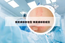 银屑病非脓包型 银屑病非脓疱型