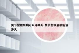 关节型银屑病可以评残吗 关节型银屑病能活多久