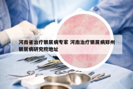 河南省治疗银屑病专家 河南治疗银屑病郑州银屑病研究院地址