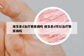 维生素d治疗银屑病吗 维生素d可以治疗银屑病吗