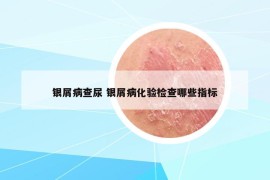 银屑病查尿 银屑病化验检查哪些指标