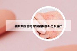 银屑病厉害吗 银屑病厉害吗怎么治疗