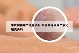 牛皮癣能用二硫化硒吗 银屑病可以用二氧化硒洗头吗