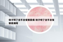 蚊子咬了会不会变银屑病 蚊子咬了会不会变银屑病呀