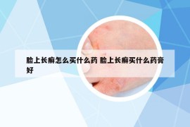 脸上长癣怎么买什么药 脸上长癣买什么药膏好