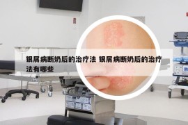 银屑病断奶后的治疗法 银屑病断奶后的治疗法有哪些