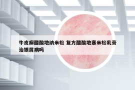 牛皮癣醋酸地纳米松 复方醋酸地塞米松乳膏治银屑病吗