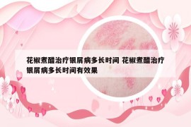 花椒煮醋治疗银屑病多长时间 花椒煮醋治疗银屑病多长时间有效果