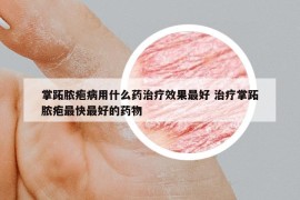 掌跖脓疱病用什么药治疗效果最好 治疗掌跖脓疱最快最好的药物