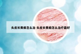 头皮长黄癣怎么治 头皮长黄癣怎么治疗最好