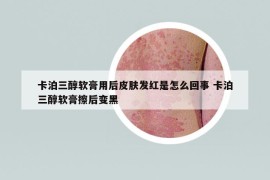 卡泊三醇软膏用后皮肤发红是怎么回事 卡泊三醇软膏擦后变黑