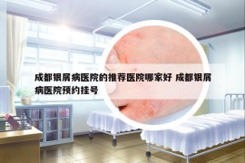 成都银屑病医院的推荐医院哪家好 成都银屑病医院预约挂号