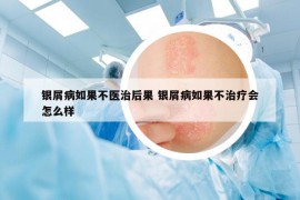 银屑病如果不医治后果 银屑病如果不治疗会怎么样