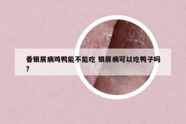 香银屑病鸡鸭能不能吃 银屑病可以吃鸭子吗?