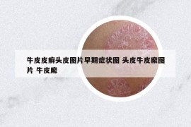 牛皮皮癣头皮图片早期症状图 头皮牛皮廨图片 牛皮廨