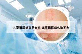 儿童银屑病容易自愈 儿童银屑病久治不愈