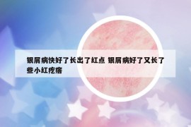 银屑病快好了长出了红点 银屑病好了又长了些小红疙瘩