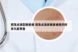 初发点滴型银屑病 初发点滴状银屑病用药好多久能恢复