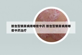 脓包型银屑病用哪些中药 脓包型银屑病用哪些中药治疗