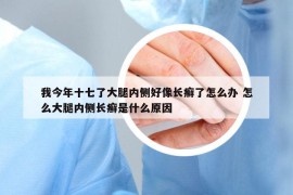 我今年十七了大腿内侧好像长癣了怎么办 怎么大腿内侧长癣是什么原因