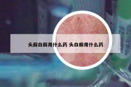 头藓白藓用什么药 头白癣用什么药