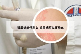 银屑病能怀孕么 银屑病可以怀孕么