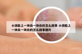 小孩脸上一块白一块白的怎么回事 小孩脸上一块白一块白的怎么回事图片