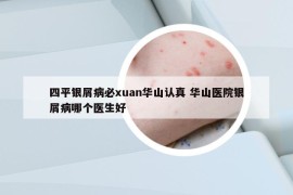 四平银屑病必xuan华山认真 华山医院银屑病哪个医生好