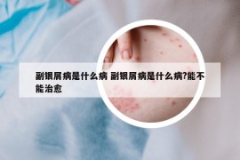 副银屑病是什么病 副银屑病是什么病?能不能治愈