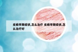 皮癣早期症状,怎么治疗 皮癣早期症状,怎么治疗好