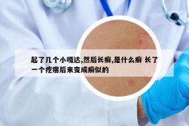 起了几个小嘎达,然后长癣,是什么癣 长了一个疙瘩后来变成癣似的