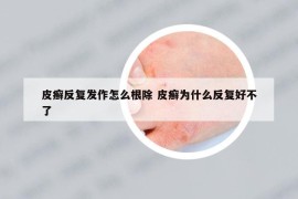 皮癣反复发作怎么根除 皮癣为什么反复好不了