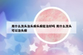 用什么洗头治头癣头癣能治好吗 用什么洗头可以治头癣