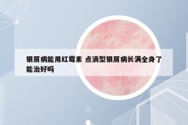 银屑病能用红霉素 点滴型银屑病长满全身了能治好吗