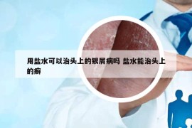 用盐水可以治头上的银屑病吗 盐水能治头上的癣