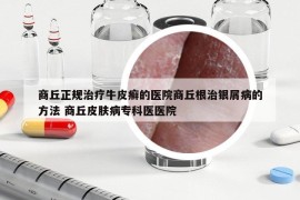 商丘正规治疗牛皮癣的医院商丘根治银屑病的方法 商丘皮肤病专科医医院