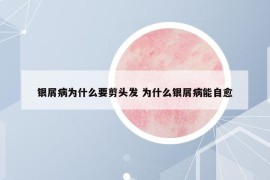 银屑病为什么要剪头发 为什么银屑病能自愈