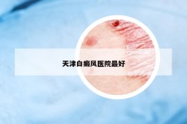 天津白癜风医院最好