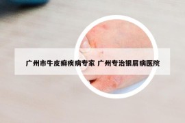 广州市牛皮癣疾病专家 广州专治银屑病医院