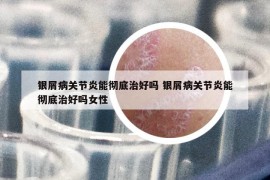 银屑病关节炎能彻底治好吗 银屑病关节炎能彻底治好吗女性