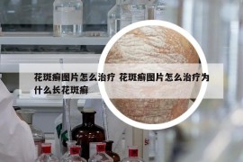 花斑癣图片怎么治疗 花斑癣图片怎么治疗为什么长花斑癣