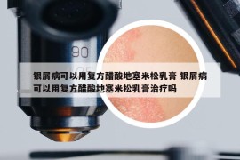 银屑病可以用复方醋酸地塞米松乳膏 银屑病可以用复方醋酸地塞米松乳膏治疗吗