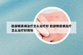 脸部银屑病治疗怎么治疗好 脸部银屑病治疗怎么治疗好得快