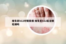 维生素b12对银屑病 维生素b12能治银蛇病吗