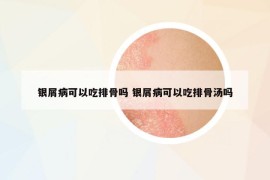 银屑病可以吃排骨吗 银屑病可以吃排骨汤吗