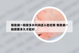 银屑病一般需多长时间进入稳定期 银屑病一般需要多久才能好