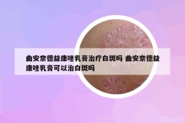 曲安奈德益康唑乳膏治疗白斑吗 曲安奈德益康唑乳膏可以治白斑吗